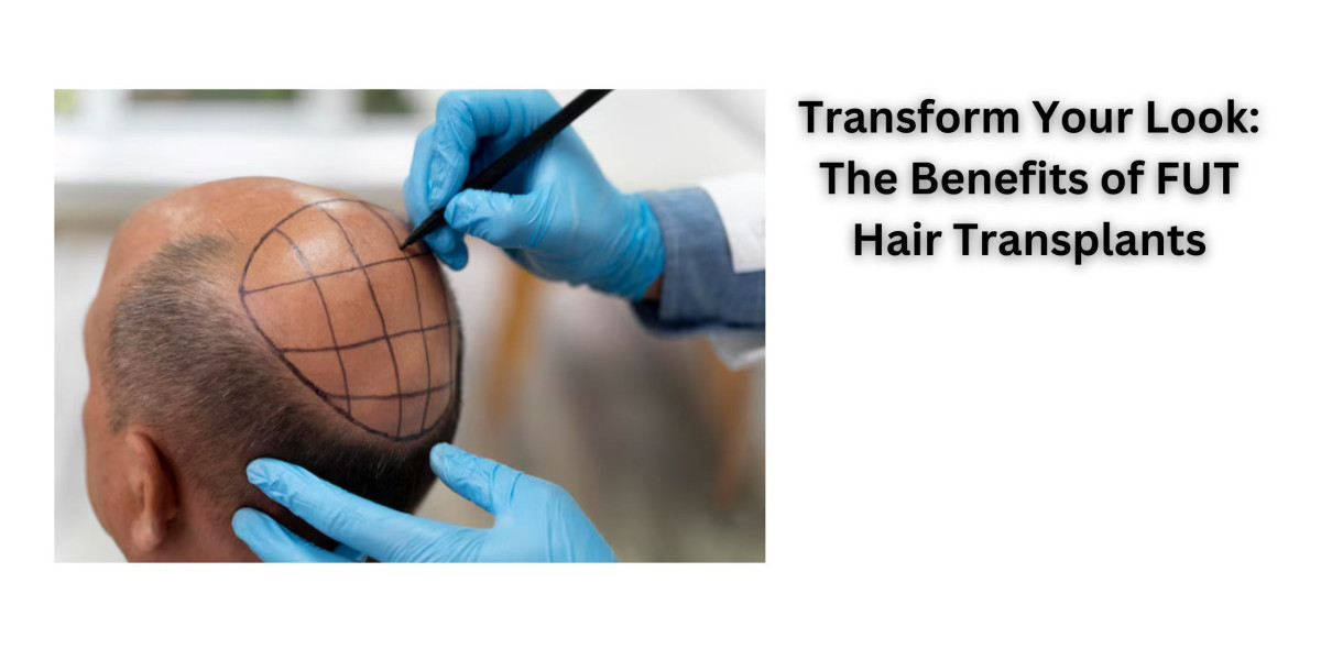 Transform Your Look: The Benefits of FUT Hair Transplants